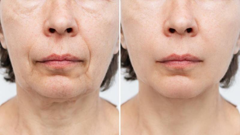 Lower face lift before and after