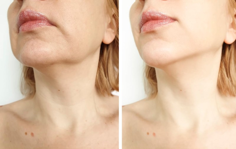 woman tightening the chin before and after the procedure